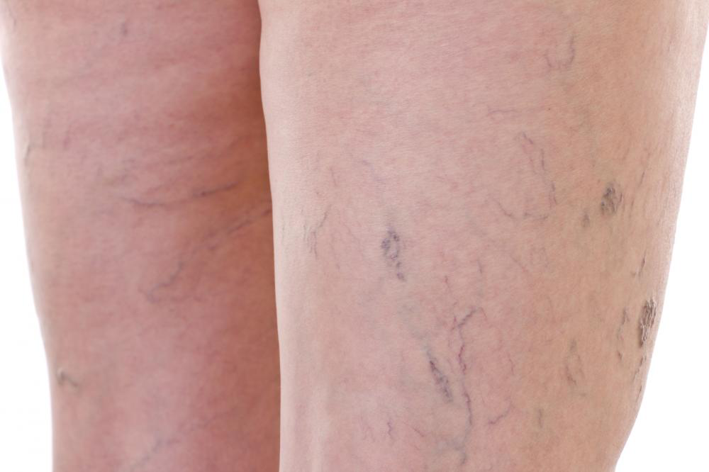 What Seniors Should Know About Varicose Veins Avantgarde Senior Living